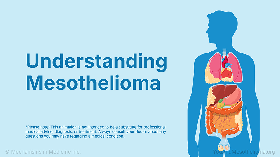 Understanding Mesothelioma