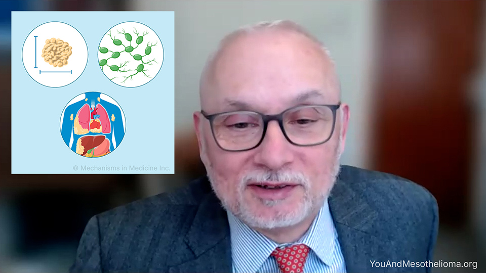 What are the stages of mesothelioma?