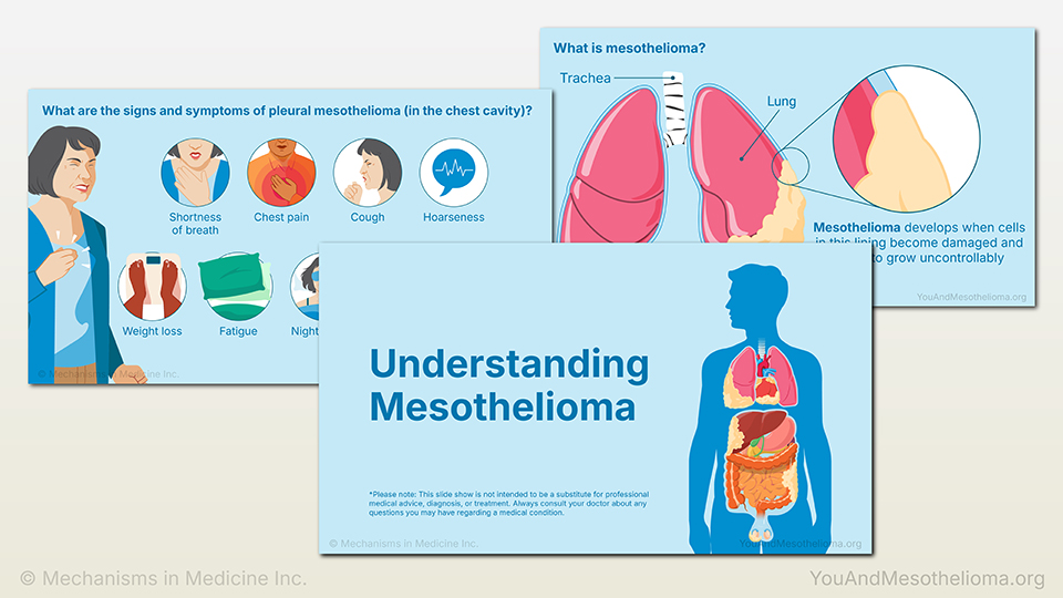 Understanding Mesothelioma
